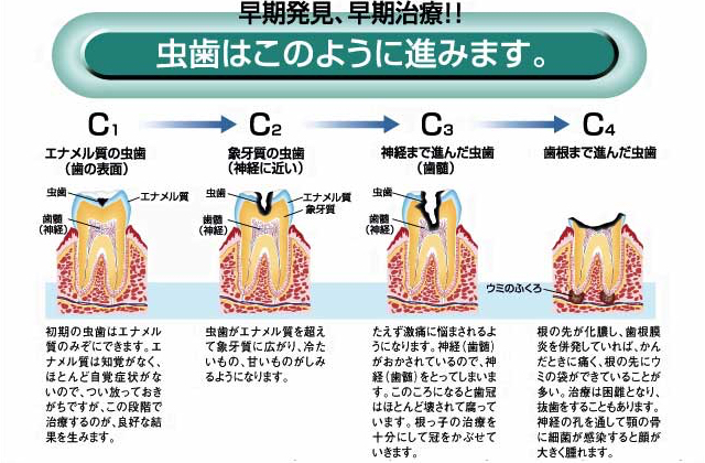 虫歯はこのように進みます。