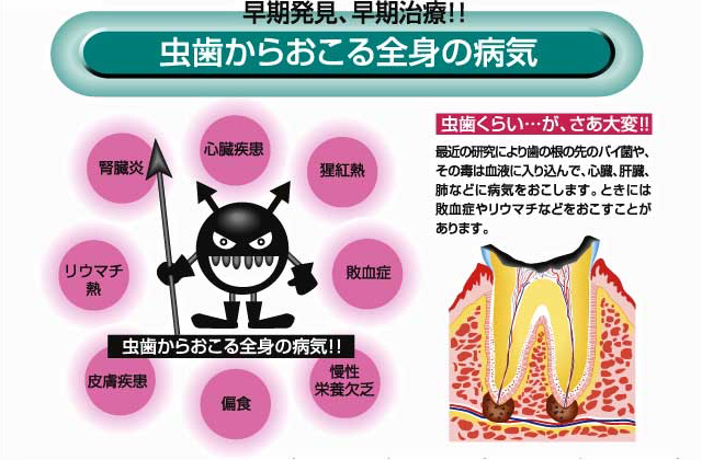 虫歯からおこる全身の病気
