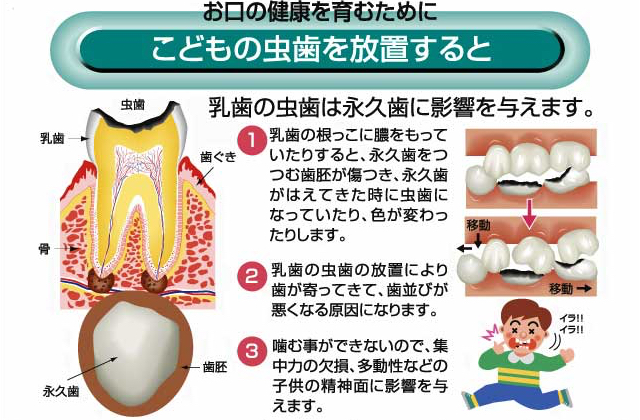 子供の虫歯を放置すると