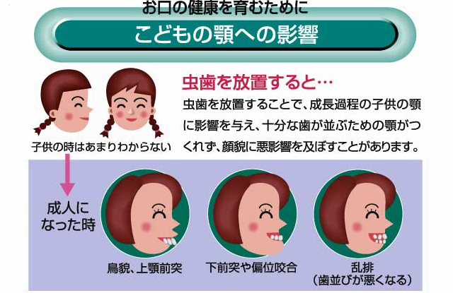 こどもの顎への影響