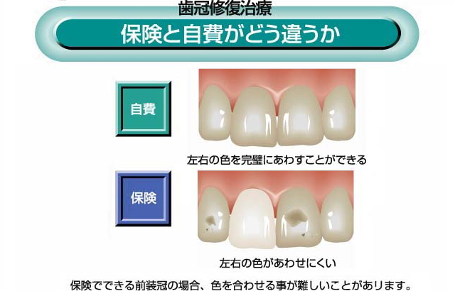保険と自費がどう違うか