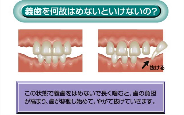 義歯を何故はめないといけないの？