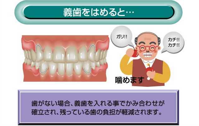 義歯をはめると…