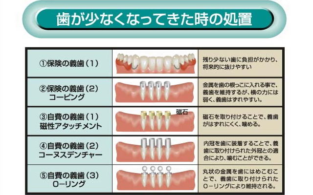 歯が少なくなってきた時の処置