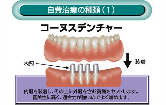 自費治療の種類(1) コーヌデンチャー