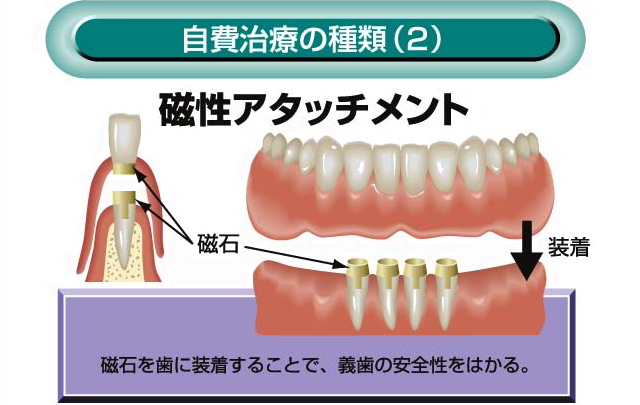 自費治療の種類(2) 磁性アタッチメント