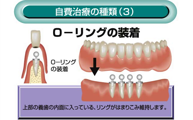自費治療の種類(3) O-リングの装着