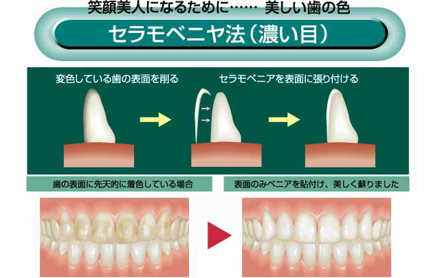 セラモベニヤ法(濃い目)