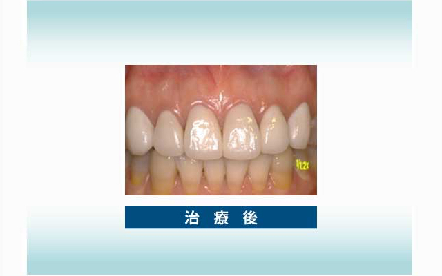 審美歯科の実例1 治療後
