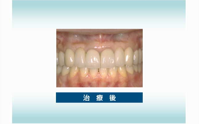 審美歯科の実例2 治療後