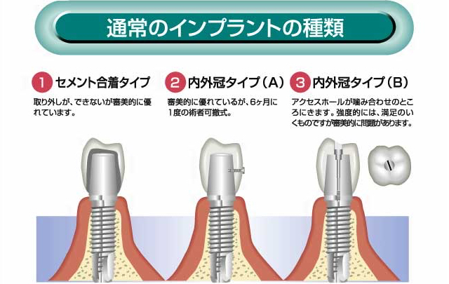 通常のインプラントの種類