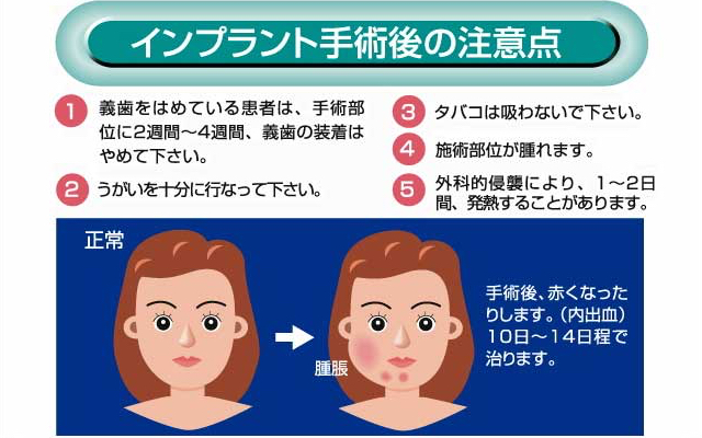 インプラント手術後の注意点