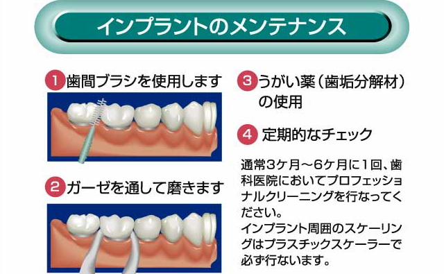 インプラントのメンテナンス
