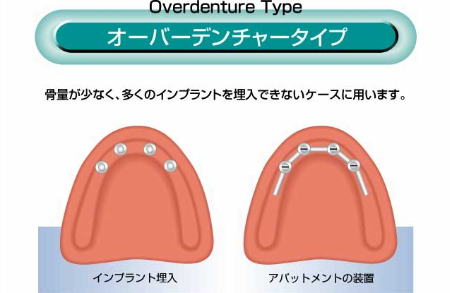 オーバーデンチャータイプ