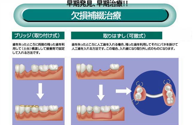 欠損補綴治療