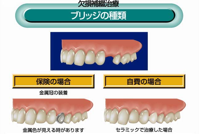 ブリッジの種類