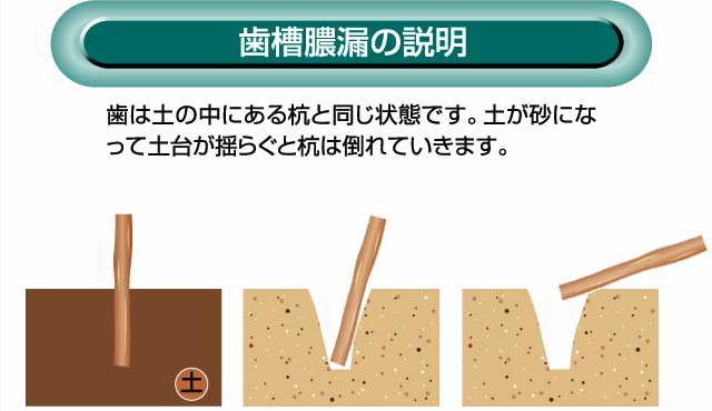歯槽膿漏の説明