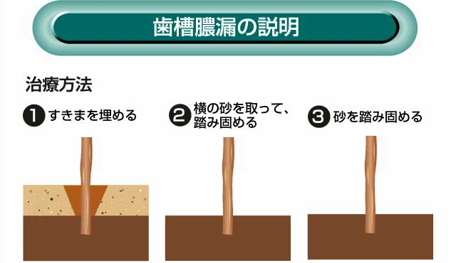 歯槽膿漏の説明