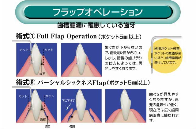 フラップオペレーション