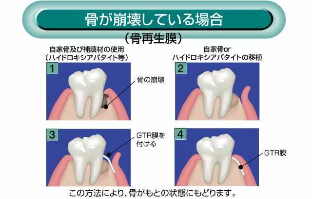 歯が崩壊している場合
