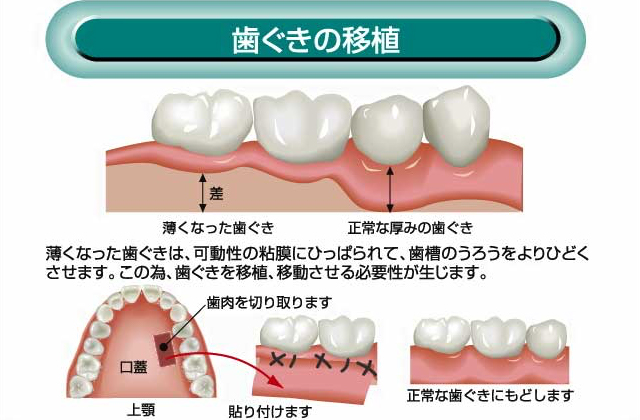 歯ぐきの移植
