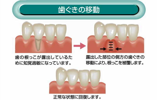 歯ぐきの移動
